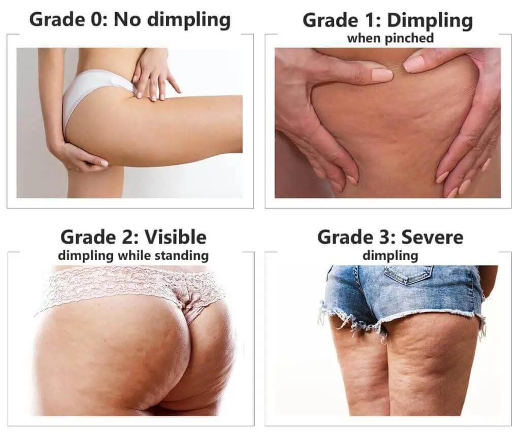 Representation of the stages of cellulite development Woburn